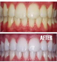 /album/photo-gallery-homepage/teeth-png2/