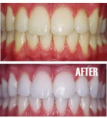 /album/photo-gallery-homepage2/teeth-png/